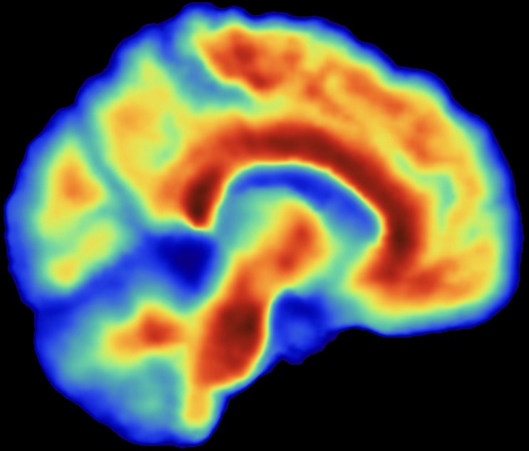 PET standardized uptake value map on the Biograph One PET/MR