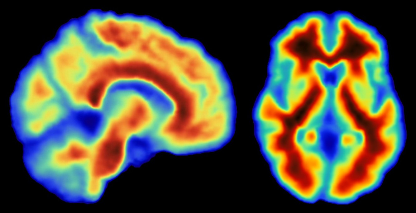 Amyloid PET: sagittal and axial standardized uptake value ratio maps