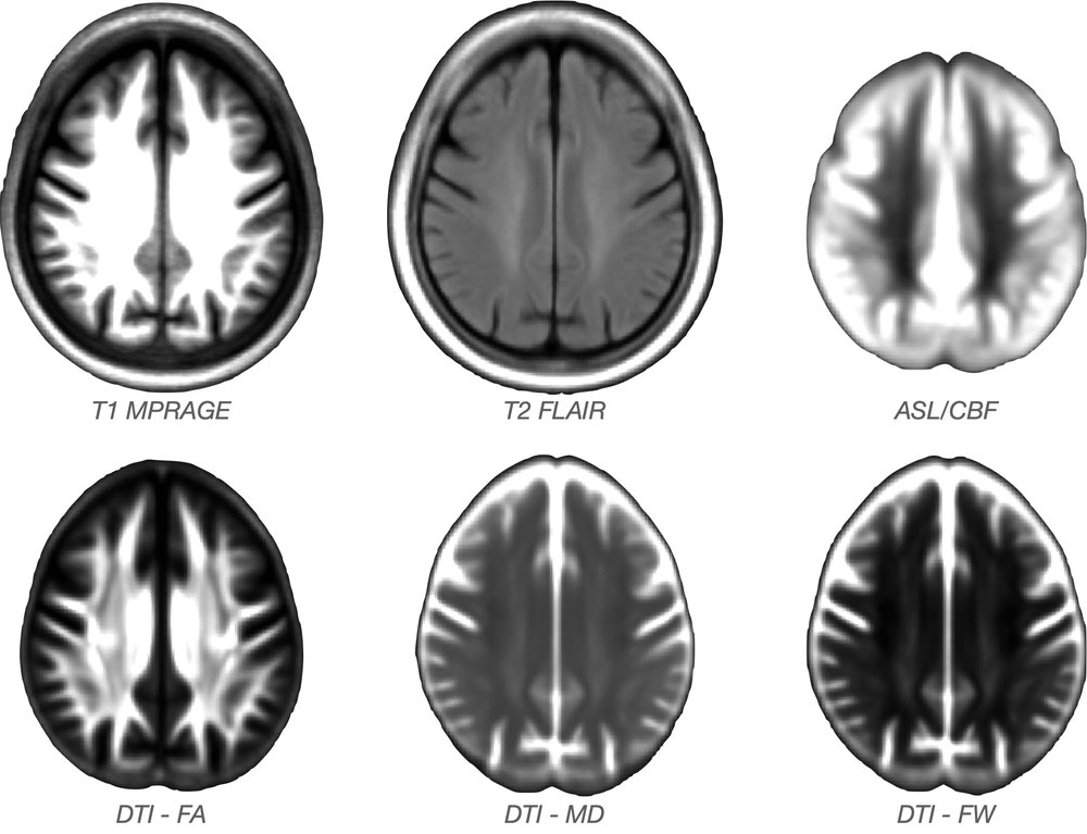 Multi-modal imaging templates: T1 MPRAGE, T2 FLAIR, ASL/CBF, DTI FA/MD/FW
