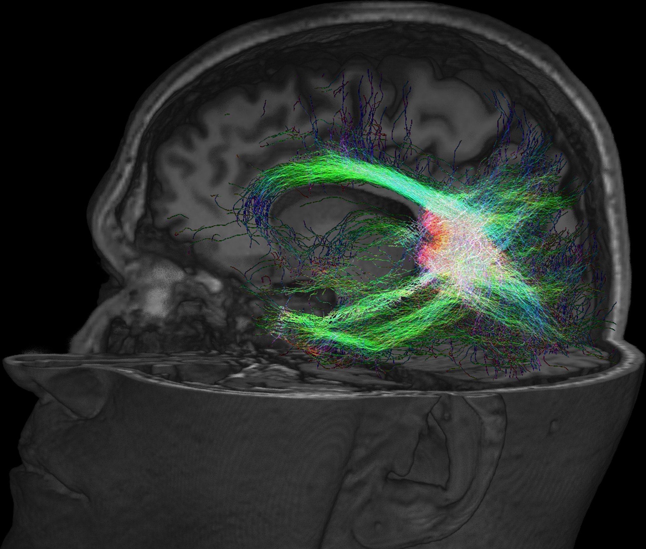 Diffusion MRI white-matter tractography on a sagittal brain